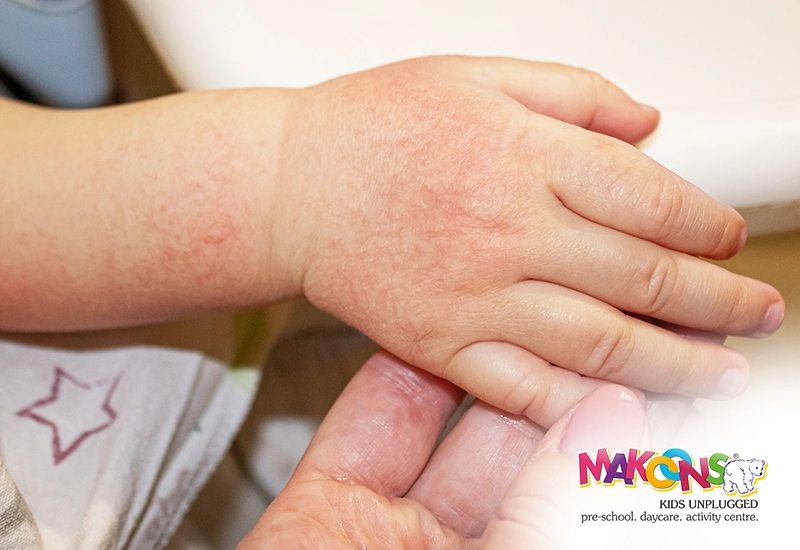 10 Natural Remedies to Soothe Your Baby’s Itchy Skin