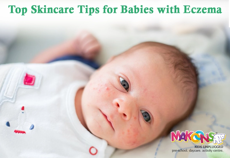 Top Skincare Tips for Babies with Eczema